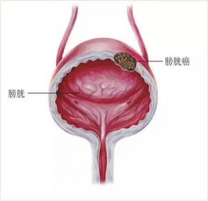 膀胱癌