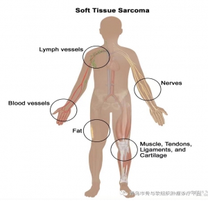 軟組織肉瘤