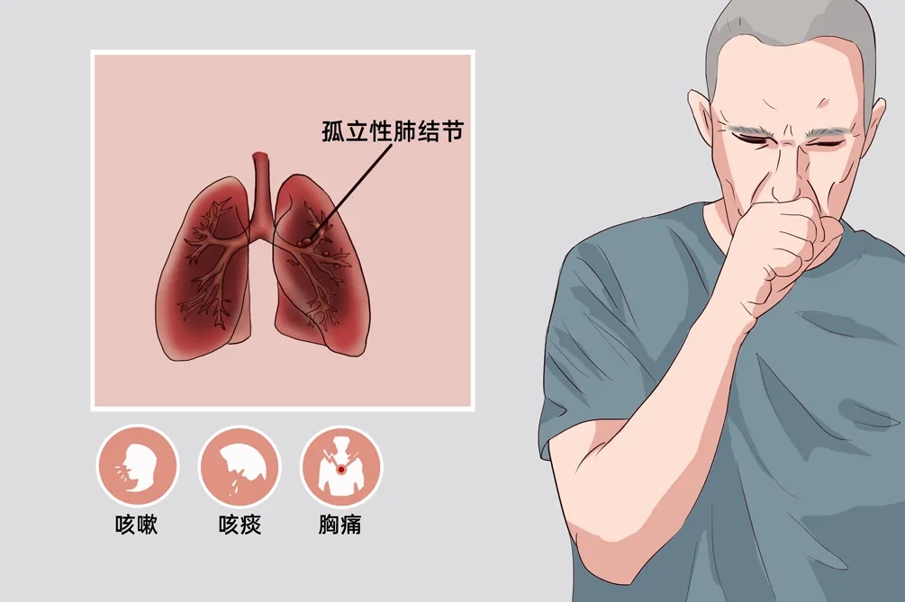 抗癌必修課——孤立性肺結(jié)節(jié)