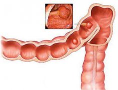 出現(xiàn)這些癥狀需馬上到醫(yī)院檢查——結(jié)腸癌